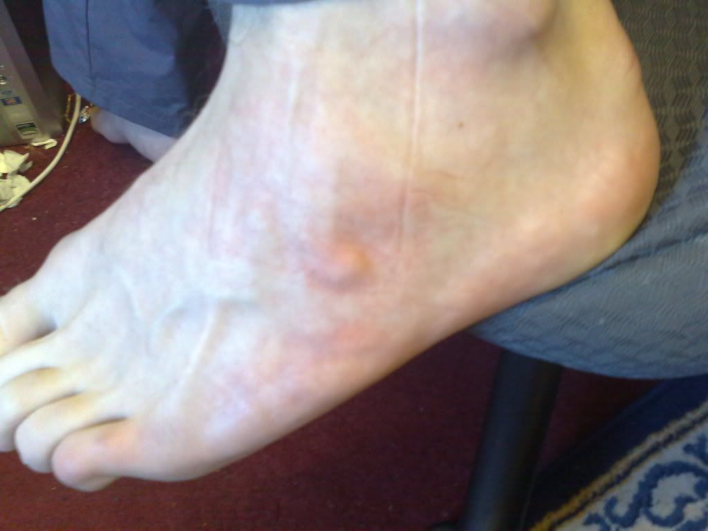 foot-lump-photo-by-md9547-photobucket